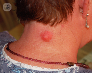 A person with a big cyst on their neck