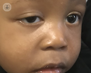 Closeup image of ptosis in a young boy