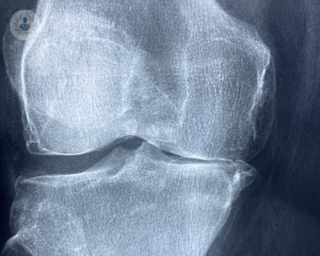 X-Ray of bone-to-bone knee arthritis 