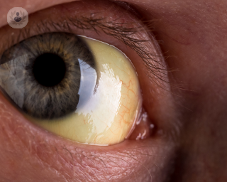 A close up of an eye with yellow colouring in the whites of their eyes due to jaundice. 