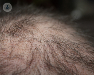 hair loss, hair transplants, men's health, aesthetic medicine, male pattern baldness, female pattern baldness