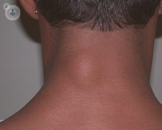 A lipoma on a patient's neck. 