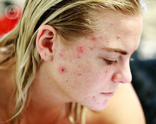 A girl with acne. 