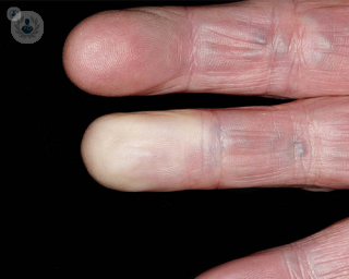 Colour change in fingers due to Raynaud's disease.