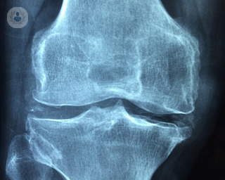 An image of a knee