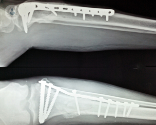 x-ray of internal fracture fixation, broken bone, fractures, orthopaedic surgery