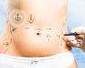 liposuction_recovery