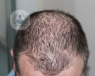 male-hair-loss