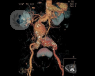 abdominal aortic aneurysm treatment