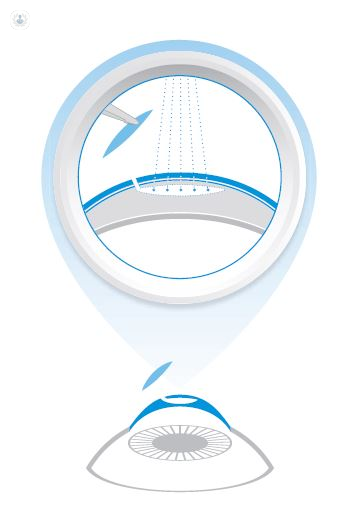 Diagram of the SMILE procedure, powered by Zeiss.