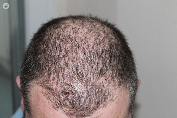 Man who requires micrograft hair transplant surgery
