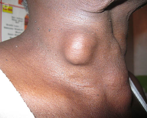 A woman with thyroid nodules