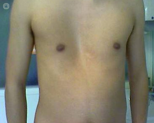 Image of a man's torso, which displays a sunken breastbone which is an indicator of pectus excavatum