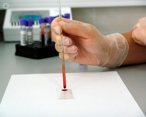Bone marrow being tested for myelofibrosis