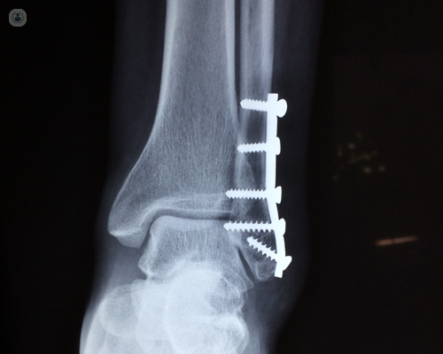 X-ray of a fracture that's been fixed with three metal pins