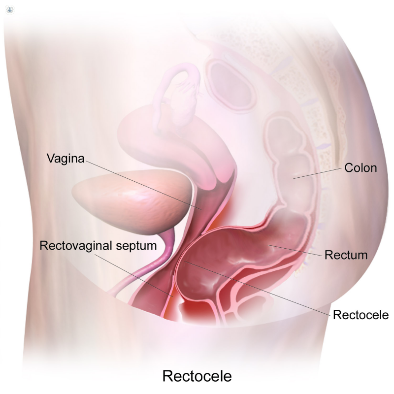 Diagram showing rectocele