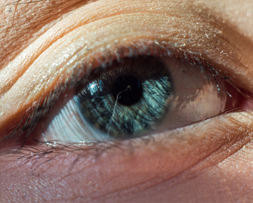 Close up of the eye of a person who has laser photocoagulation