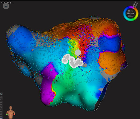 3d mapping image of catheter ablation
