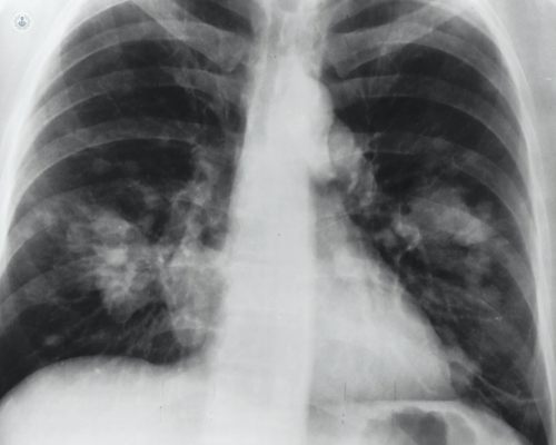 X-ray of possible lung cancer