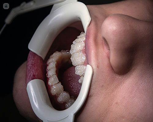 person receiving endodontic treatment