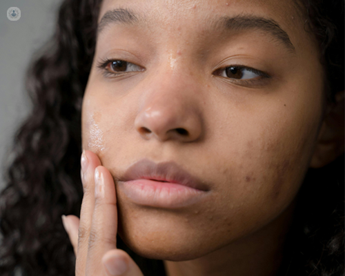 Girl who's being treated for adolescent acne