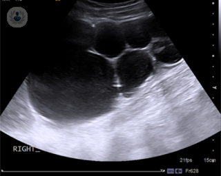 Multicystic dysplastic kidney (MCDK) scan