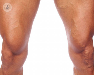 What are varicose veins, and what causes them?