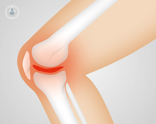 A knee with arthritis.
