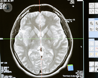 A brain CT scan