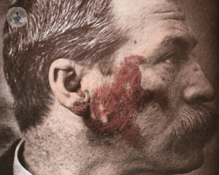 Man with lupus rash on his face
