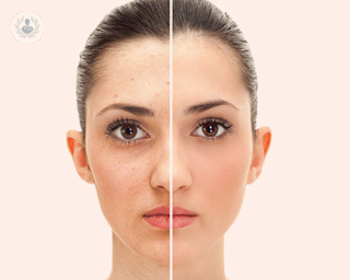 A facelift procedure can do wonders when it comes to rejuvenating the physical appearance of the face and can make patients look up to 15 years younger.