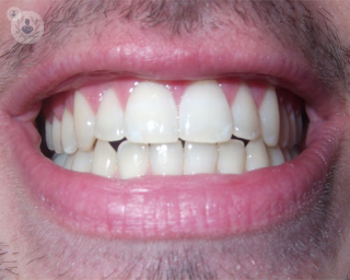 A photo of someone's teeth. 