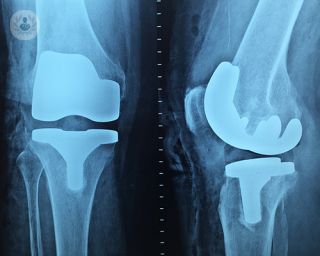 An x-ray of a knee replacement