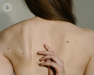 A body shot of a woman's back, showing a few moles.