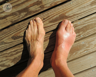 A person's two feet are standing on a wooden surface. The left foot is in regular condition whereas the right foot is painfully red and swollen due to gout.
