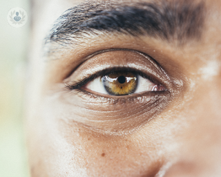A close up of a man's brown eye. He is looking directly into the camera lens. Lens replacement surgery remove the natural lens and injects an artificial lens.