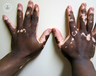 vitiligo-skin