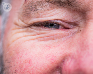 Can cataracts be reversed or improved without surgery?