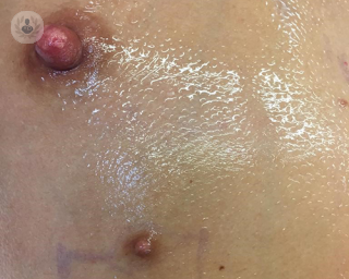 Pic of a third nipple from a patient of Brian Simons