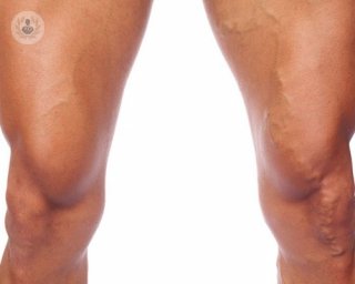 A man's legs with varicose veins.