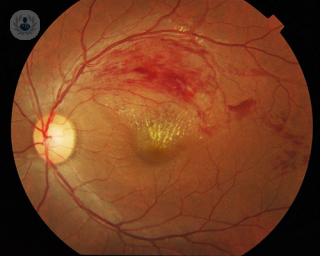 branch retinal vein occlusion