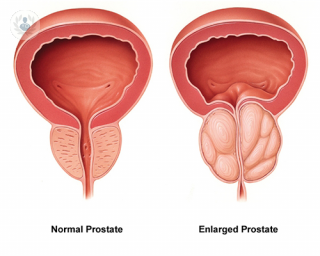 enlarged_prostate