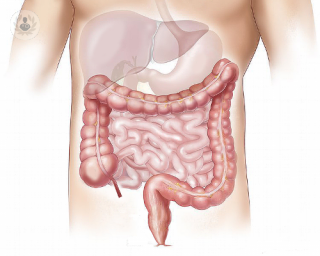 bowel-cancer