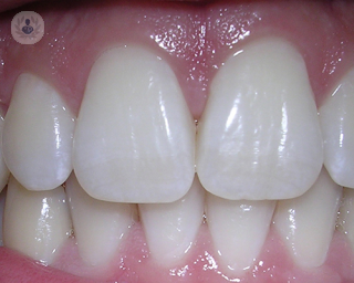 perfect white teeth