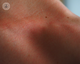 Red and irritated skin, which are possible signs of a skin allergy, on a person's collarbone.