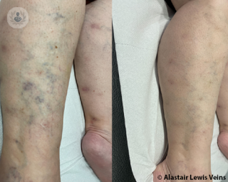 Before and after results of varicose veins treatment