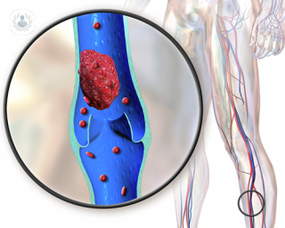 How is deep vein thrombosis treated?