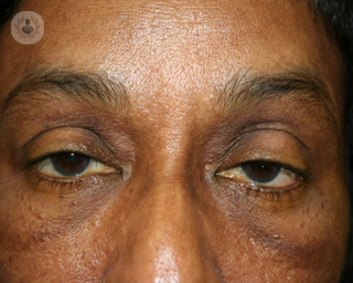Close up of eye and nose area of woman patient with ptosis