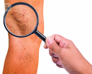 What is ultrasound-guided foam sclerotherapy? Find out in our latest article. 