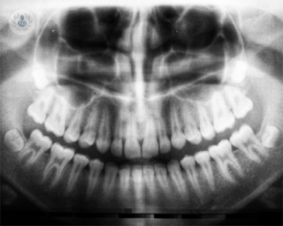 An X-ray showing partially erupted wisdom teeth